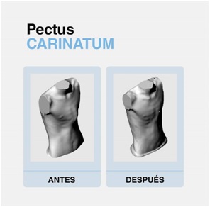 Pectus Carinatum Antes y después