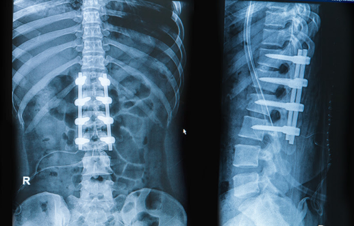 Columna implante